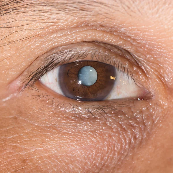 Cataract — Stock Photo, Image