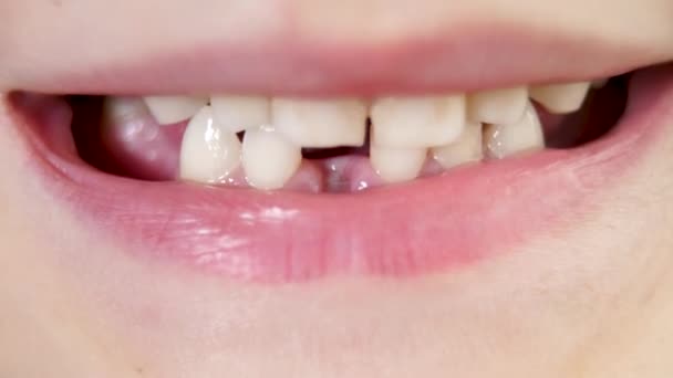 最初の赤ちゃんの歯または一時的な歯の損失 — ストック動画
