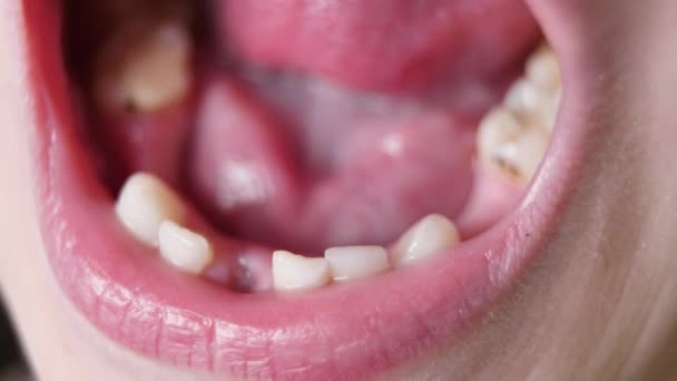 Los dientes de bebé se caen, se rompen, se vuelven negros, se infectan. Caries en niños — Vídeos de Stock