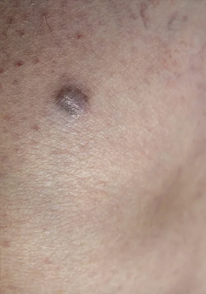 Close View Human Skin Human Skin Sarcoma Large Suspicious Dangerous — Stock Photo, Image