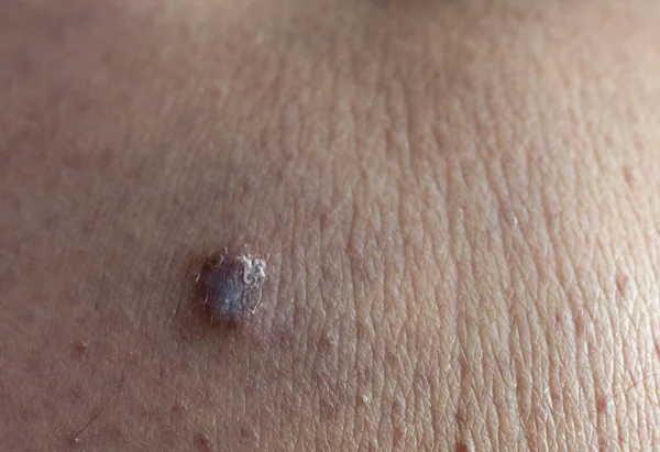 人間の皮膚肉腫と人間の皮膚のクローズアップビュー 皮膚の上に大きな怪しい危険なスパイ — ストック写真