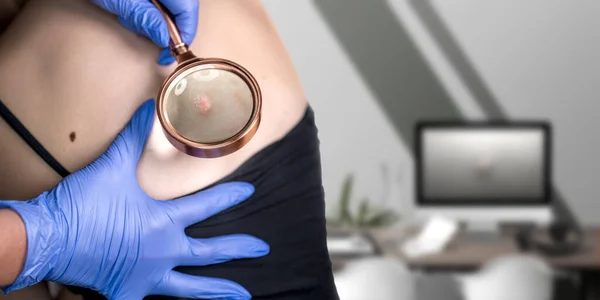 Close Shooting Doctor Medicsl Gloves Examines Growths Woman Skin Magnifying Стоковая Картинка