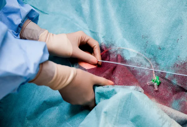 Médicos mãos colocando cateter de coronarografia — Fotografia de Stock