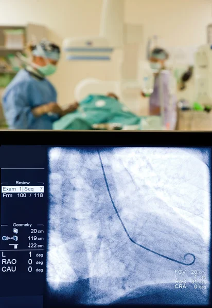 X-ray obrazovky coronarography chirurgii — Stock fotografie