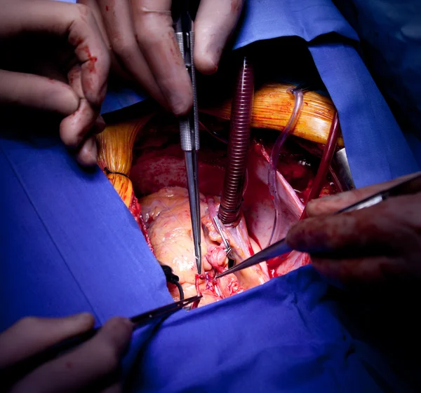 Cardiac surgery heart operation — Stock Photo, Image