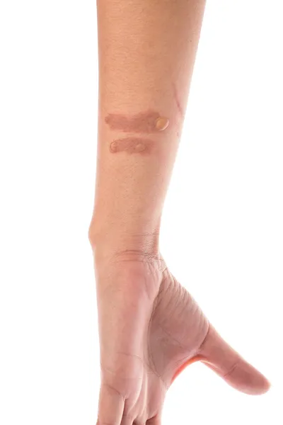 Andra graden skålla Bränn blåsa på underarm — Stockfoto