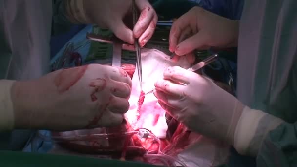 Шунтирование коронарной артерии — стоковое видео