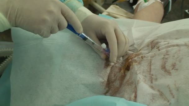 中心静脉穿刺和插管 — 图库视频影像