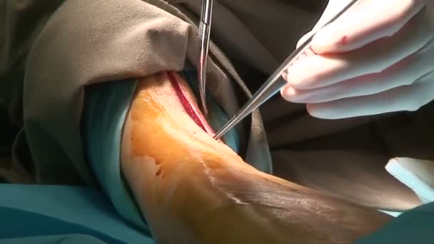 Surgery on leg — Stock Video