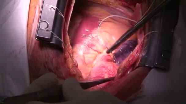 Cirugía cardiaca en quirófano — Vídeos de Stock