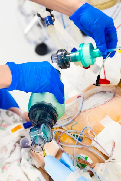 Kunstmatige ventilatie met zak-ventiel-masker — Stockfoto