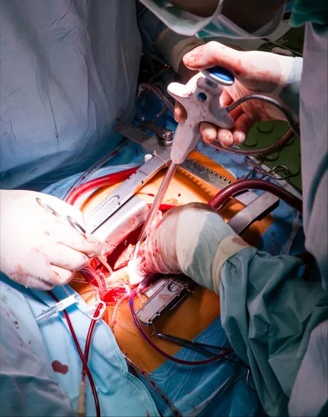 Cardiac surgery — Stock Photo, Image