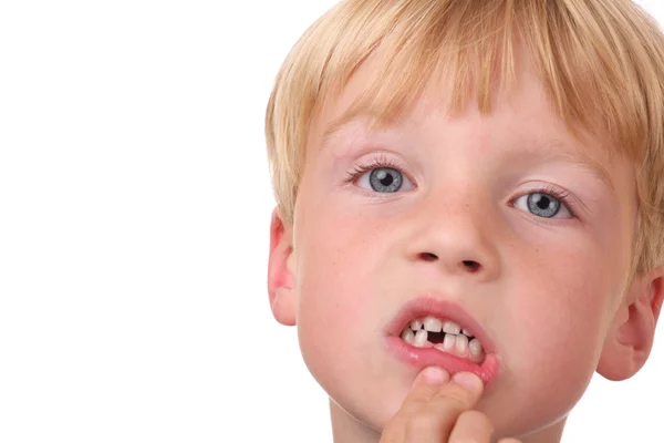 Отсутствующие зубы — стоковое фото