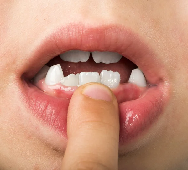 Child shows tooth — Stock Photo, Image