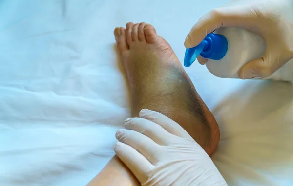 Arzt Cremt Verletztes Bein Ein — Stockfoto