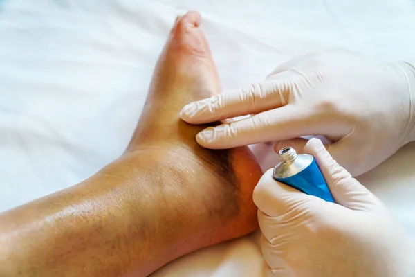 Doctor Smears Injured Leg Patient Gel — Stock Photo, Image