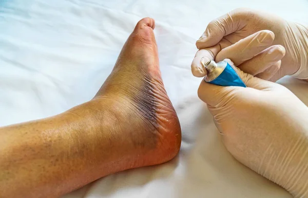 Врач Мажет Поврежденную Ногу Пациента Гелем — стоковое фото