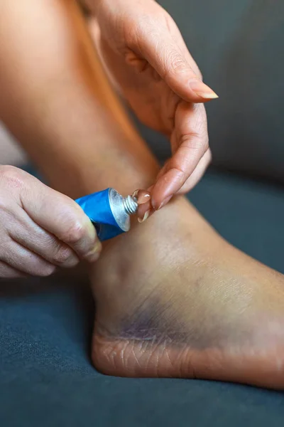 Mujer Aplica Gel Pierna Lesionada — Foto de Stock