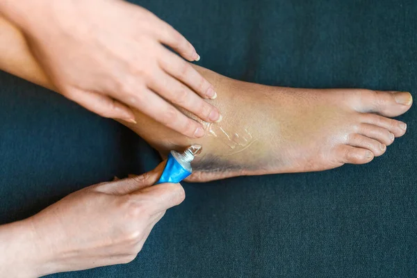 Frau Trägt Gel Auf Ihr Verletztes Bein Auf — Stockfoto