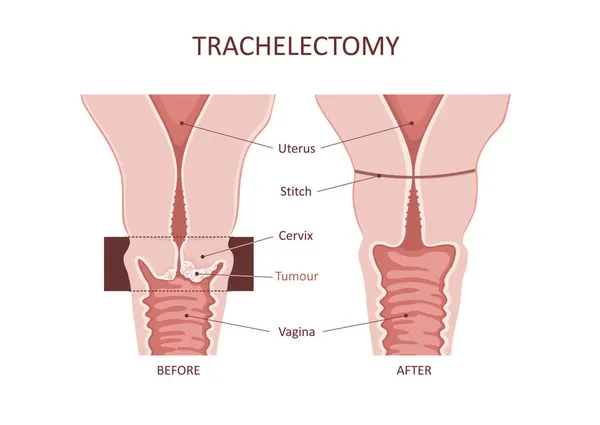 Trachelectomy - chirurgické odstranění děložního čípku. Předtím a potom. Karcinom děložního čípku — Stockový vektor