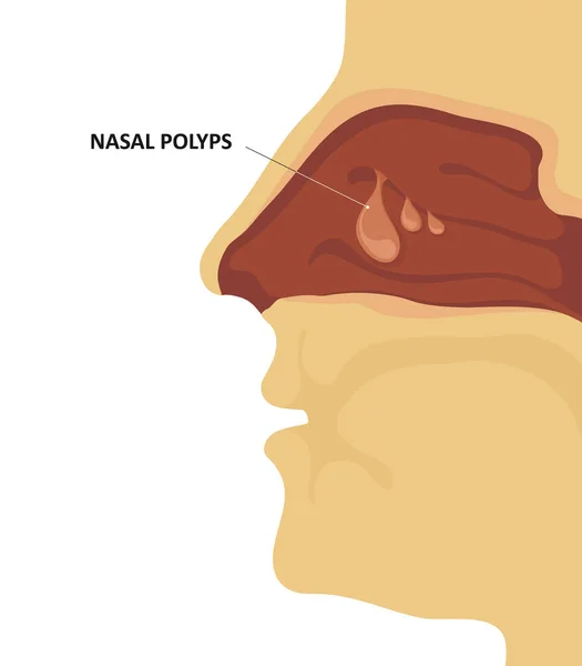 Pólipos nasales. Congestión sinusal. Ilustración vectorial — Archivo Imágenes Vectoriales