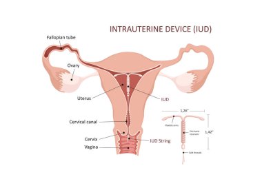 Rahim içi aygıt. Doğum kontrol yöntemi, IUD. Hamileliğin kontrolü ve korunması. Rahimde rahim içi cihaz var.