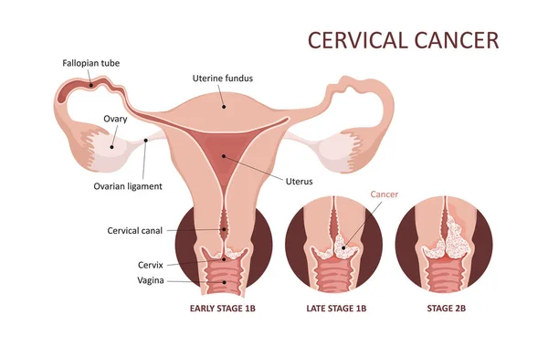 Imagen del desarrollo del cáncer cervical. Estadios del carcinoma de cuello uterino. Sistema reproductivo femenino. Anatomía. Ginecología. — Vector de stock