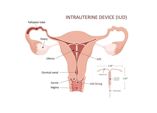 Intrauterine Vorrichtung. Verhütungsmethode, IUD. Kontrolle und Schutz der Schwangerschaft. Intrauterines Gerät in der Gebärmutter — Stockvektor