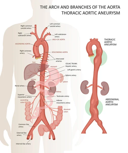 Aortans valv och grenar. Ortaaneurysm i bröstet — Stock vektor