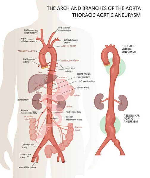 The arch and branches of the aorta. Thoracic aortic aneurysm — Stockový vektor