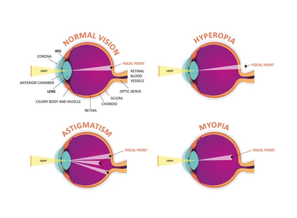 Defeitos oculares. Visão normal, Hipermetropia, Miopia. — Vetor de Stock