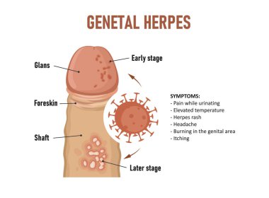 Genital uçuk. Herpes simplex virüsü