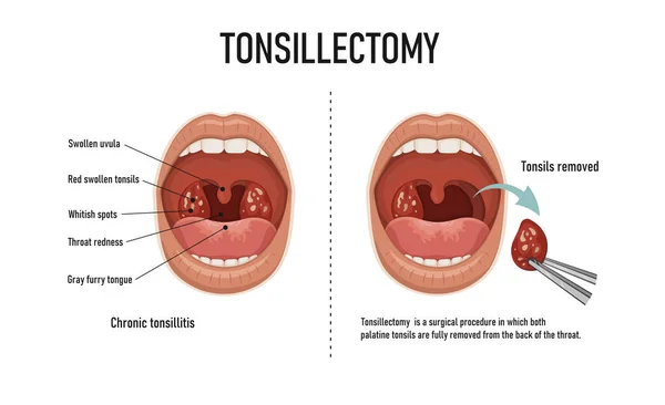 Tonsillectomy Removal Palatine Tonsils Acute Pharyngitis —  Vetores de Stock