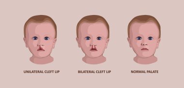 Cleft palate in a child. Reconstruction of the upper palate. Plastic surgery clipart