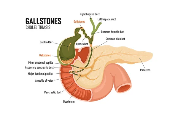 Cholelithiasis Cholecystitis Formations Gallbladder Blockage Bile Duct Pancreas — Vettoriale Stock