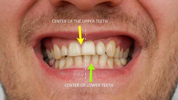 Estomatologia Ortodontia Deslocamento Linha Média Dos Dentes Dentes Tortos — Fotografia de Stock