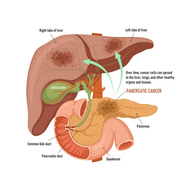 Cancer Pancréas Propagation Des Cellules Cancéreuses Pancréas Foie — Image vectorielle