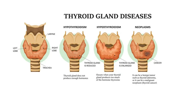 Maladies Des Glandes Thyroïdes Hyperthyroïdie Hypothyroïdie Néoplasmes — Image vectorielle