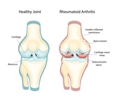 Rheumatoid Arthritis RA that usually affects knees. the auto immune disease. Vector Illustration clipart
