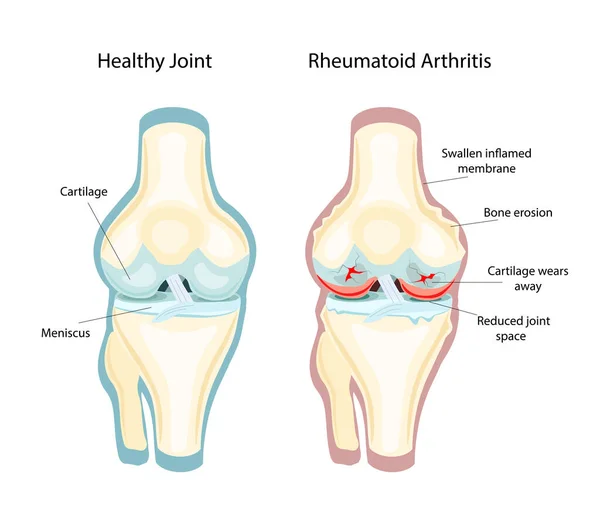 Ревматоидный артрит РА, который обычно поражает колени. аутоиммунное заболевание. Векторная миграция — стоковый вектор