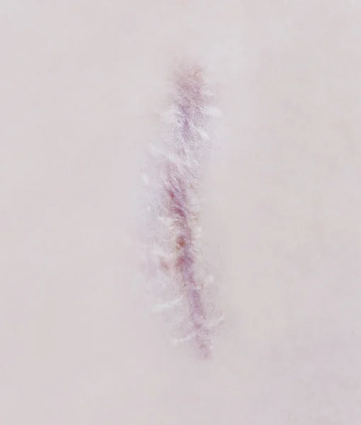 Carta cicatrizante I en piel humana —  Fotos de Stock
