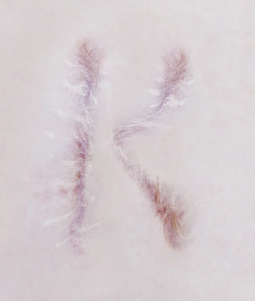 Litera cicatrice K pe pielea umană — Fotografie, imagine de stoc