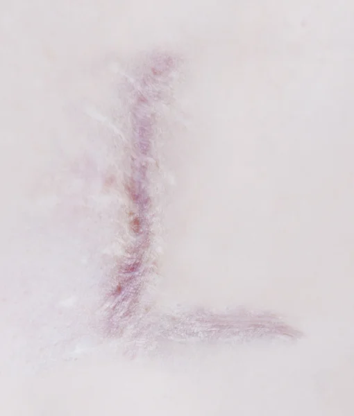 Cicatriz letra L na pele humana — Fotografia de Stock