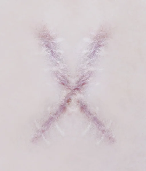 Scar letter X on human skin — Stock Photo, Image