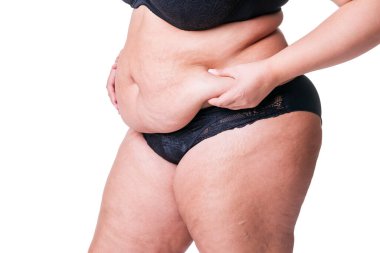 Göbek gerdirme, sarkık deri, göbeğinde çatlaklar, beyaz arka planda izole edilmiş plastik cerrahi kavramı.