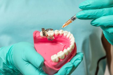 Diş hekiminin elleri, diş barajı kıskacı ve anestezili bir şırınga ile insan çenesinin planını tutuyor..