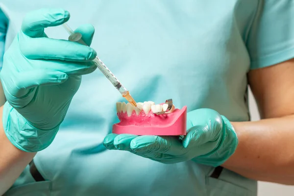 Mãos Dentista Segurando Layout Mandíbula Humana Uma Seringa Com Anestésico Imagem De Stock