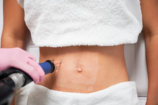 Close up of womans abdomen exposed to laser polishing. Visible traces in form of white dots immediately after procedure. CO2 laser is effective method of treating scars and postpartum stretch marks.