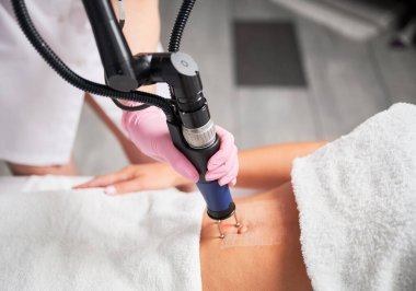 Tedaviden hemen sonra karbondioksit lazeriyle deri görüntüsü. Lazer cihazı yavaş yavaş karın derisi üzerinde hareket ediyor, cilt iltihaplı tedavi alanı için maksimum alanı sağlıyor.