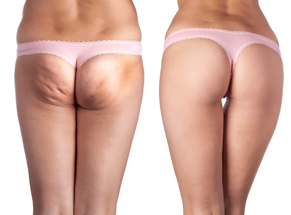 Cellulite Arsch und schönen Arsch. — Stockfoto